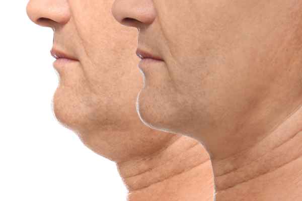 HIFU - Breakthrough in Anti - ageing 2 hifu results Stratford-upon-Avon