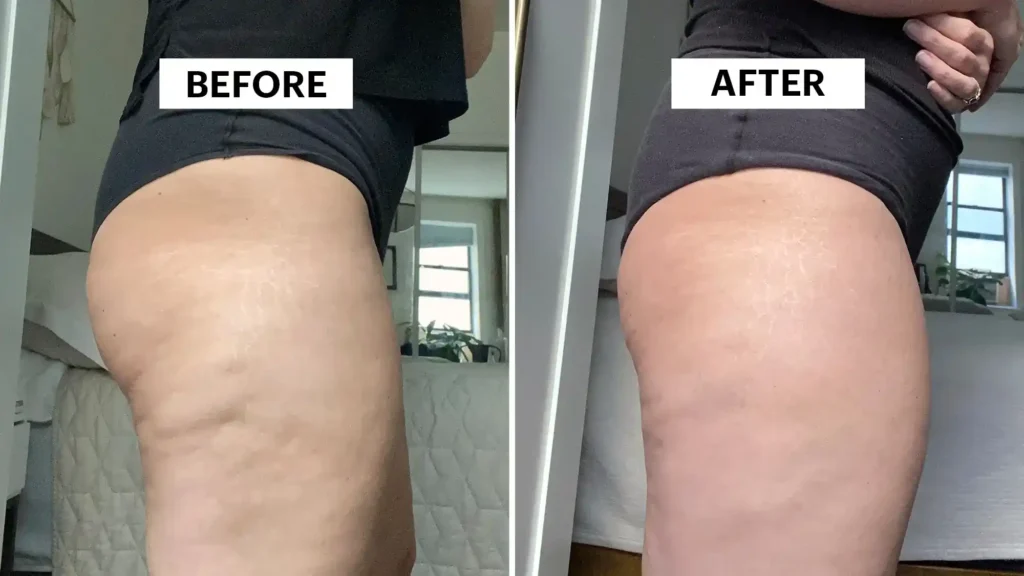 Sculpting Your Bum: Can Toning Exercises Really Reduce Cellulite? 1 Do Toning Exercise Stratford-upon-Avon Really Tackle Cellulite?