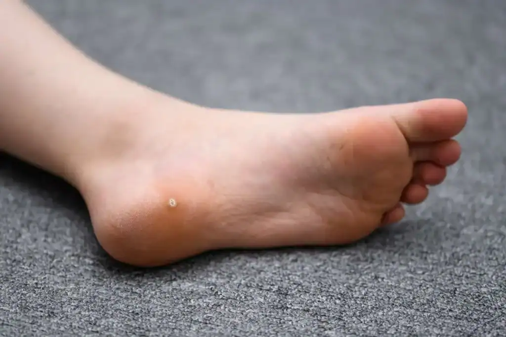 Cryotherapy For Warts And Also Verrucas 2 Image of verruca on the bottom of the foot that able to be treated with Cryotherapy Stratford-upon-Avon