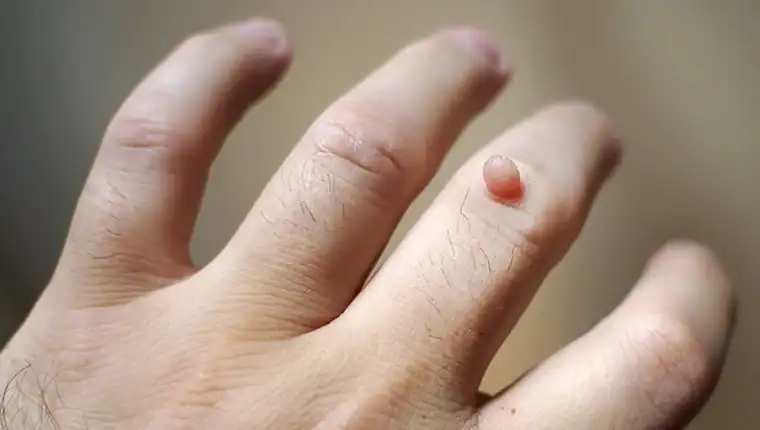 Image of blemish that Cryotherapy Stratford-upon-Avon can remove with Lipo 360.