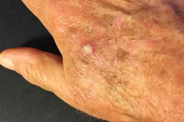 Cryopen For Actinic Keratoses 1 Image of Actinic keratoses Stratford-upon-Avon on a person hand