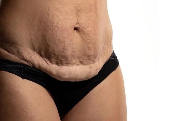 The Science of Skin Tightening 1 The science behind skin tightening Stratford-upon-Avon picture of a woman's sagging skin on the stomach